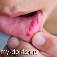 Аллергический стоматит - MY-DOKTOR.RU