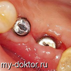 Формирование десны: имплантация зуба - MY-DOKTOR.RU
