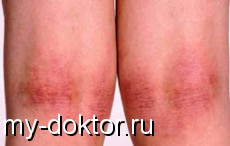 Критерии диагностики атопического дерматита - MY-DOKTOR.RU