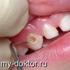 Пломбирование зубов при кариесе - MY-DOKTOR.RU