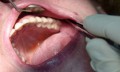 Плюсы и минусы имплантации зубов - MY-DOKTOR.RU