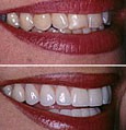 Виниры: реальная альтернатива реставрации зубов. Виды виниров. - MY-DOKTOR.RU
