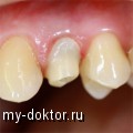 Абатменты из циркония в современной стоматологии - MY-DOKTOR.RU