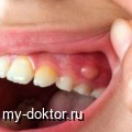 Абсцесс зуба: лечение и профилактика - MY-DOKTOR.RU