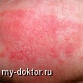 Эксфолиативный дерматит - MY-DOKTOR.RU