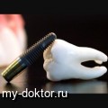 Экспресс имплантация зубов - MY-DOKTOR.RU