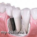 Имплантация – лучший выход при полной потере зубов - MY-DOKTOR.RU
