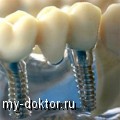 Как проводится имплантация зубов - MY-DOKTOR.RU
