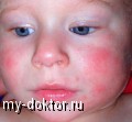 Контактный дерматит - MY-DOKTOR.RU