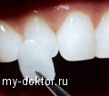 Коррекция зубов с помощью виниров - MY-DOKTOR.RU