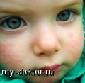 Лечение крапивницы у малышей - MY-DOKTOR.RU