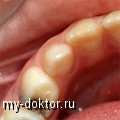 Лечение пульпита без боли и брекет системы в Санкт-Петербурге - MY-DOKTOR.RU