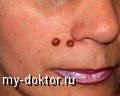 Методы избавления от бородавок на лице - MY-DOKTOR.RU