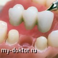 Несъемное протезирование мостами – самый востребованный способ восстановления целостности зубного ряда - MY-DOKTOR.RU