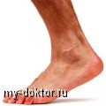 Осложнение на ноги при диабете - MY-DOKTOR.RU