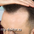 Пересадка волос - MY-DOKTOR.RU