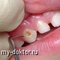 Пломбирование зубов при кариесе - MY-DOKTOR.RU