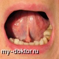 Пузырьки на языке: причины и лечение - MY-DOKTOR.RU