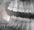 Рентген зубов увеличивает риск рака щитовидной железы - MY-DOKTOR.RU