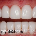 Реставрационное отбеливание зубов VS традиционное отбеливание - MY-DOKTOR.RU