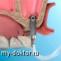 Синус-лифтинг в стоматологии - MY-DOKTOR.RU