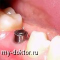 Виды зубных имплантов - MY-DOKTOR.RU