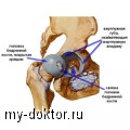 Всё об артрите тазобедренного сустава: видео — отличие артрита от артроза - MY-DOKTOR.RU